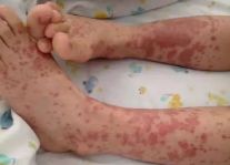 尿液有泡泡会是尿毒症吗,尿液气泡一直不消一定是肾病吗