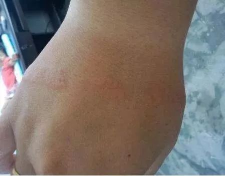 眉间纹抬头纹祛皱效果好吗,祛皱淡纹美容院