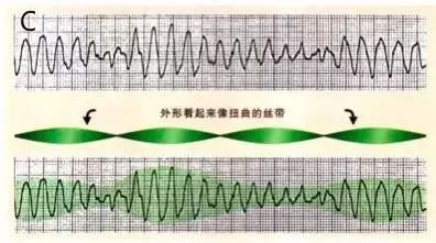 常见心律失常的识别和处理,心衰合并恶性心律失常的治疗策略