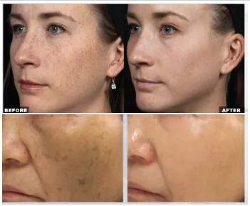 5个祛斑小妙招淡化晒斑雀斑痘印,晒斑痘印怎么消除的最快方法