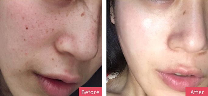 严重痘印晒斑,5个祛斑小妙招淡化晒斑雀斑痘印