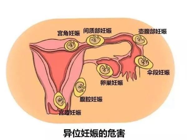 异位妊娠发病率是多少,你对肿瘤了解多少