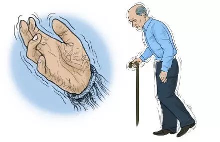 帕金森患者可以去康复中心吗,得了帕金森的医生给别人做手术