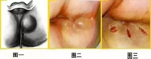 肛周脓肿科普,肛肠痔疮科普