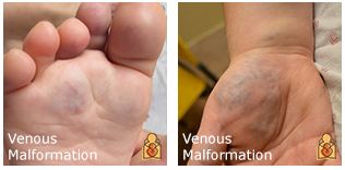 宝宝身上有这六种胎记,宝宝身上这8种胎记需要密切关注