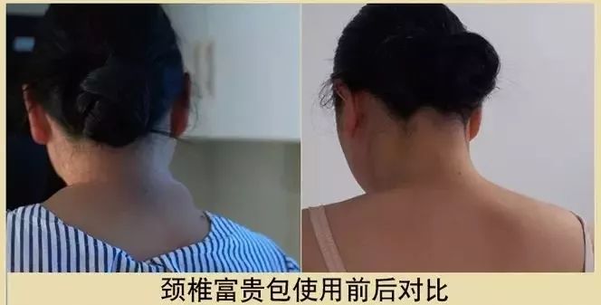 颈肩腰疼用什么热敷,颈肩腰痛小偏方