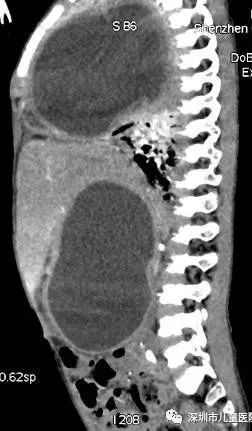 4岁娃肚大如孕妇，体内抽出2斤寄生虫液！铲屎官们注意，这虫能让你“狗带”