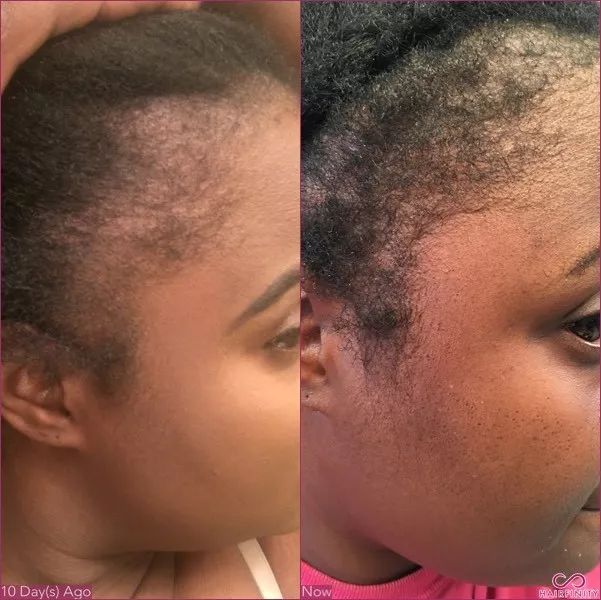 养发防脱拯救发际线洗发水,生发发际线的神器测评