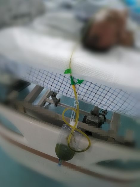 负压引流器从胃内引流出黄色液体,负压引流5天了怎么还有血