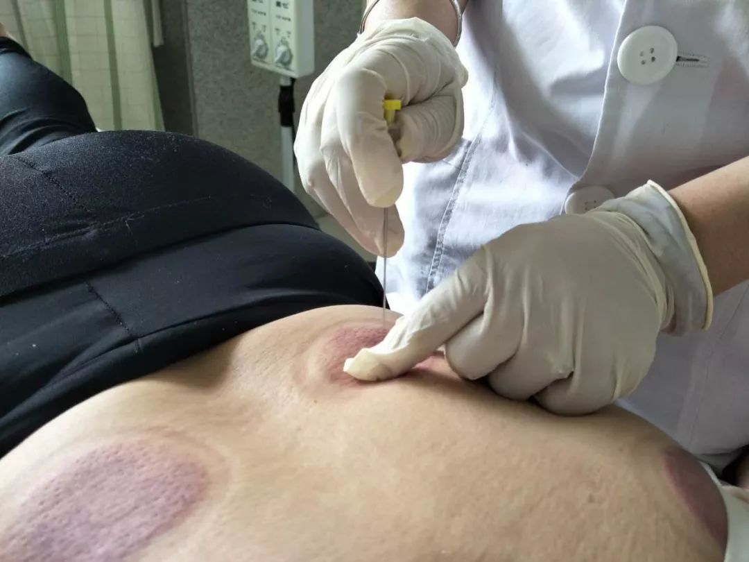 中医拔火罐治疗带状疱疹,带状疱疹中医称呼是什么