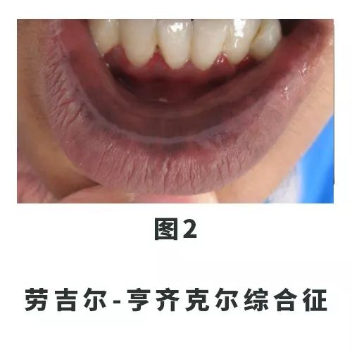 口唇黑斑,口腔里和嘴唇长满了黑点
