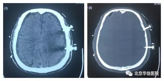 头部外伤后慢性硬脑膜下血肿,老人外伤引起颅内血肿症状表现