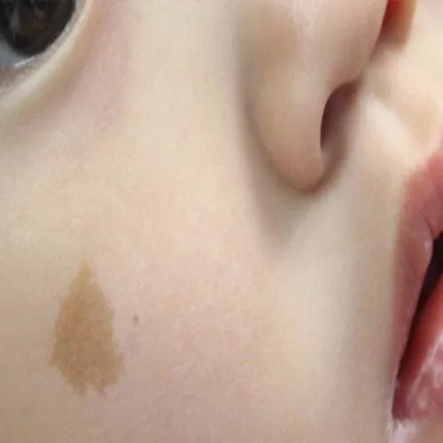 咖啡斑为什么叫咖啡,咖啡斑是喝咖啡引起的吗