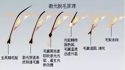 六大激光美容项目注意事项