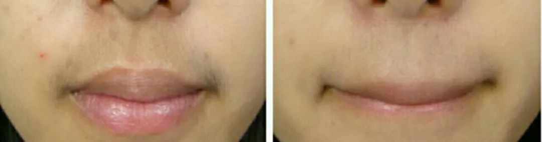 激光去唇毛小胡子效果,拯救小胡子