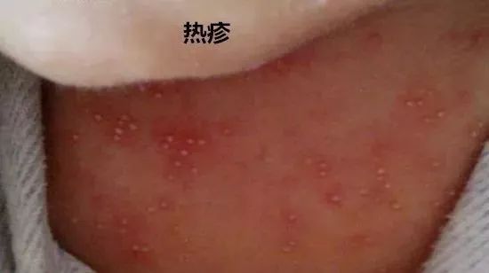 婴儿湿疹和热疹的区别在哪里,婴儿湿疹和热疹区别在哪里