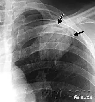 胸部解剖及常见疾病影像表现,胸部影像学基础知识
