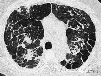 胸部解剖及常见疾病影像表现,胸部影像学基础知识