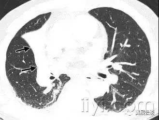 胸部解剖及常见疾病影像表现,胸部影像学基础知识
