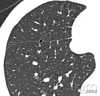 胸部解剖及常见疾病影像表现,胸部影像学基础知识