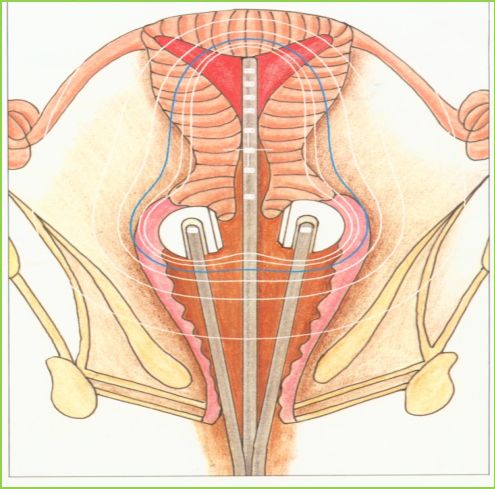 妇产科普|“隐形的手术刀”——揭秘宫颈癌的放射治疗(上)