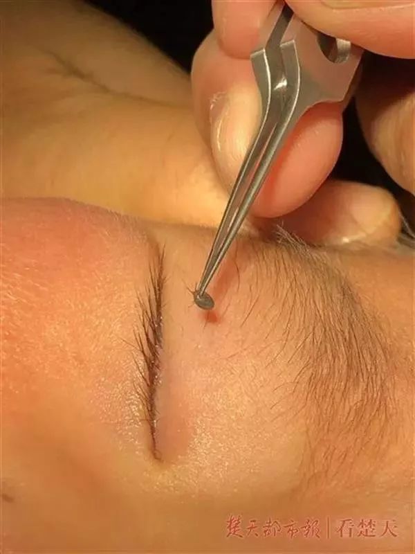 男童眼皮突然有了痣,小孩眼皮上突然出针尖大的红点