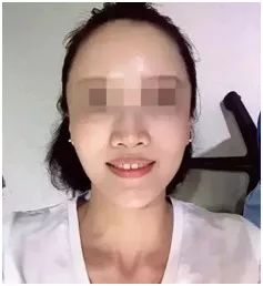 无锡缺牙优惠补贴多少钱,缺牙人士看过来种牙补贴免费领