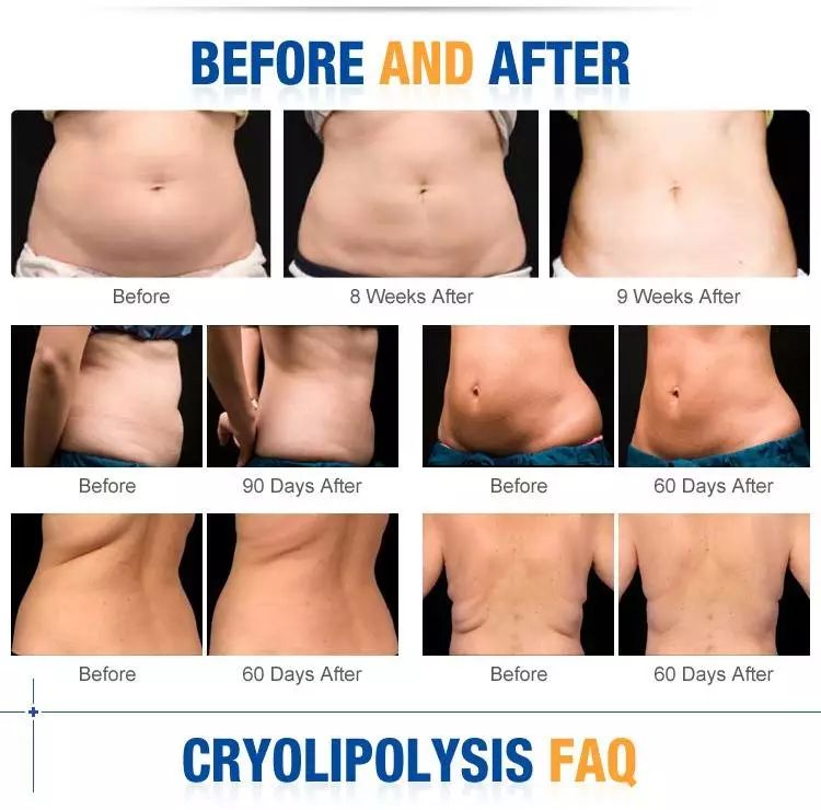 零下100多度的冷冻治疗,零下120度的超低温治疗