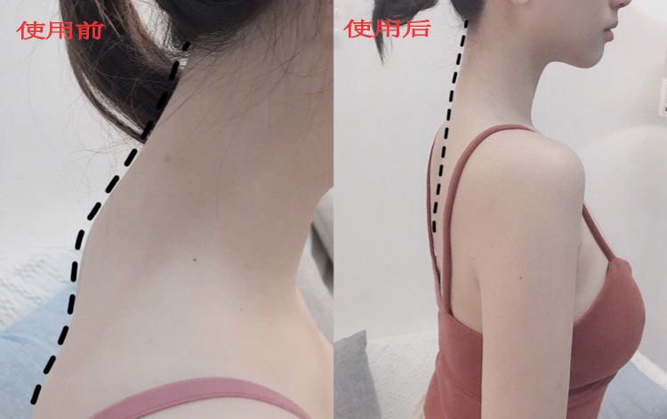 有什么方法可以改善含胸驼背,含胸驼背改善的方法