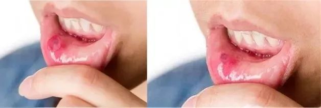 牙龈上火牙周护理牙膏,牙龈上火牙膏