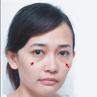 眼袋松弛下垂最快解决方法,严重眼袋下垂松弛怎么恢复