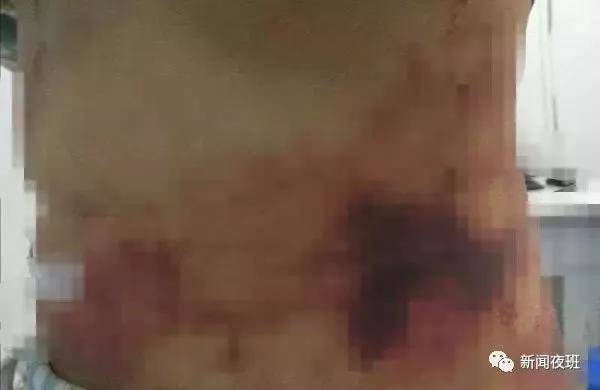 37岁女子吸脂,广西30岁姑娘吸脂