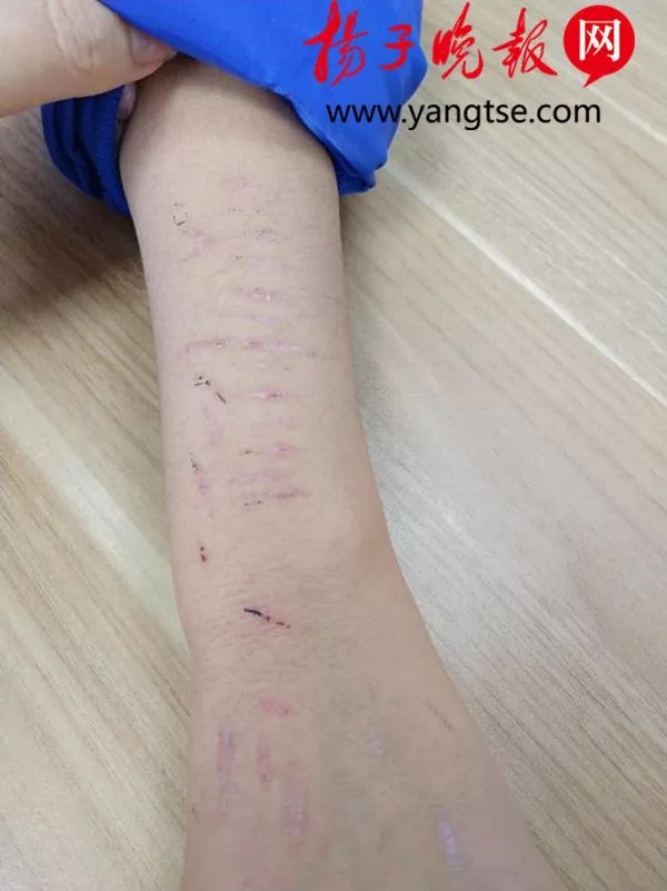 女孩手臂上十几条刀疤,14岁女生胳膊上有刀痕