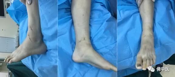【高超】玻璃人迎来新生！佛中医多科协作成功治疗血友病性踝关节炎少年