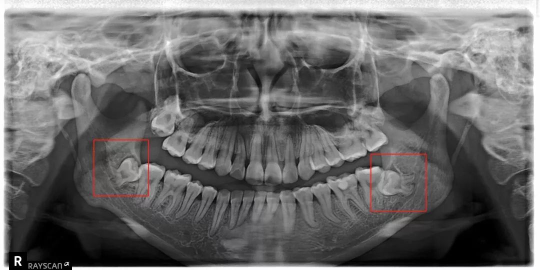 拔智齿注意事项漫画,漫画科普牙科