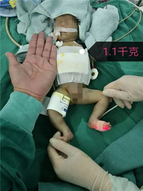 奇迹！日照一名2斤2两早产儿成功获救！