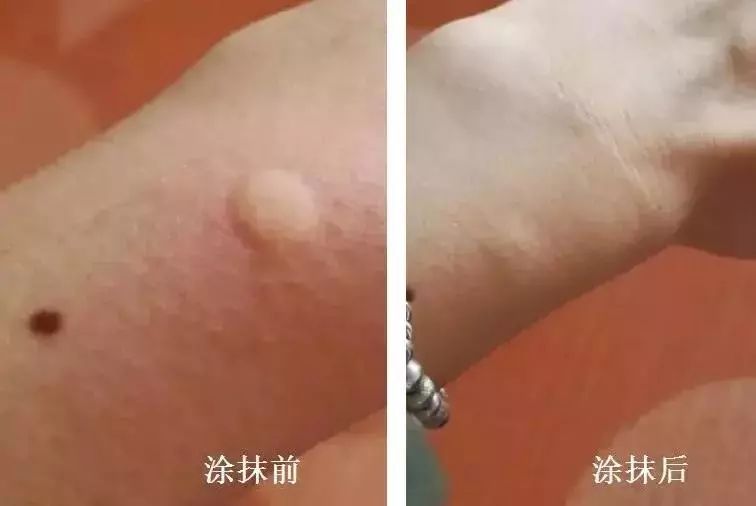 泰国防蚊虫叮咬药膏推荐,蚊子叮咬泰国青草膏哪种止痒最快