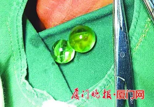 厦门5岁男孩把两颗玻璃珠塞进*体下**,还和姐姐一起瞒着父母!结果