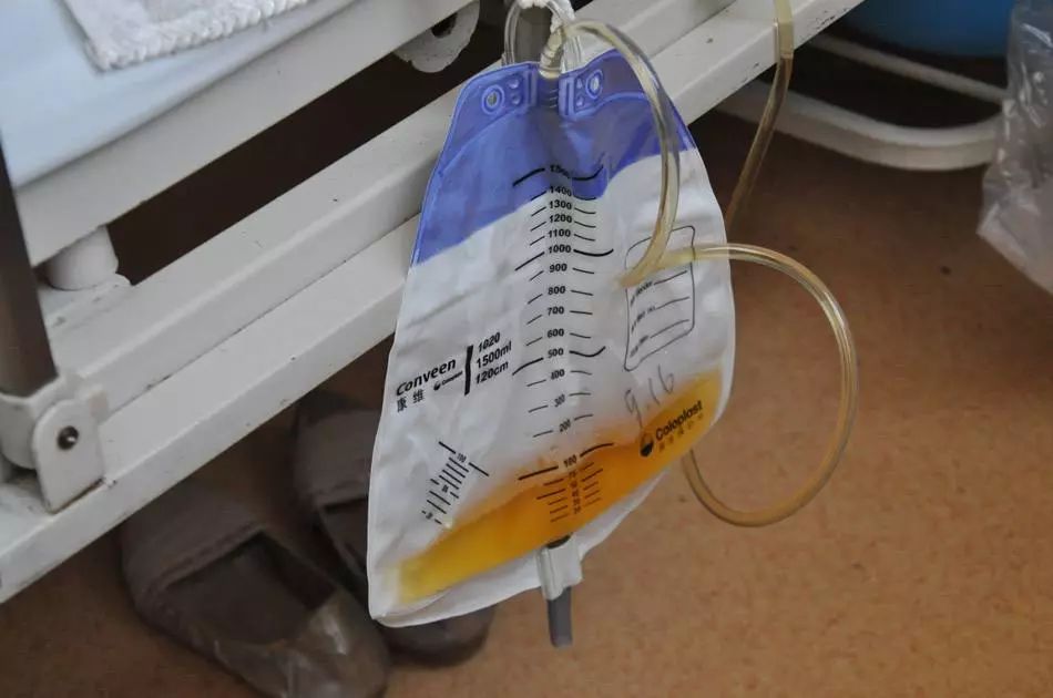 拔除导尿管后如何训练自行排尿,拔掉尿管排尿困难应如何处理