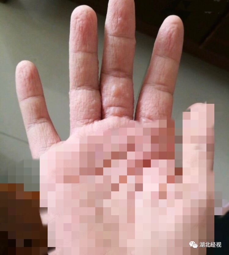 小女孩手上起了许多小水泡很痒,手上长小水泡痒一挠一大片