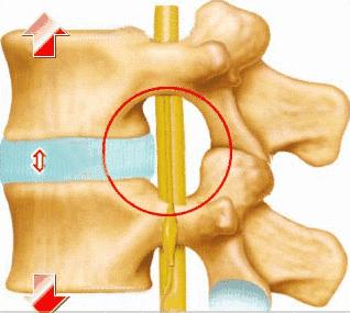 4-5椎间盘膨出严重吗,产后膨出怎么自测