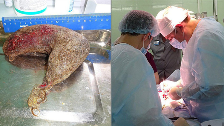 俄罗斯16岁少女肚皮鼓肿如孕妇医生手术取出11斤重“毛怪物”