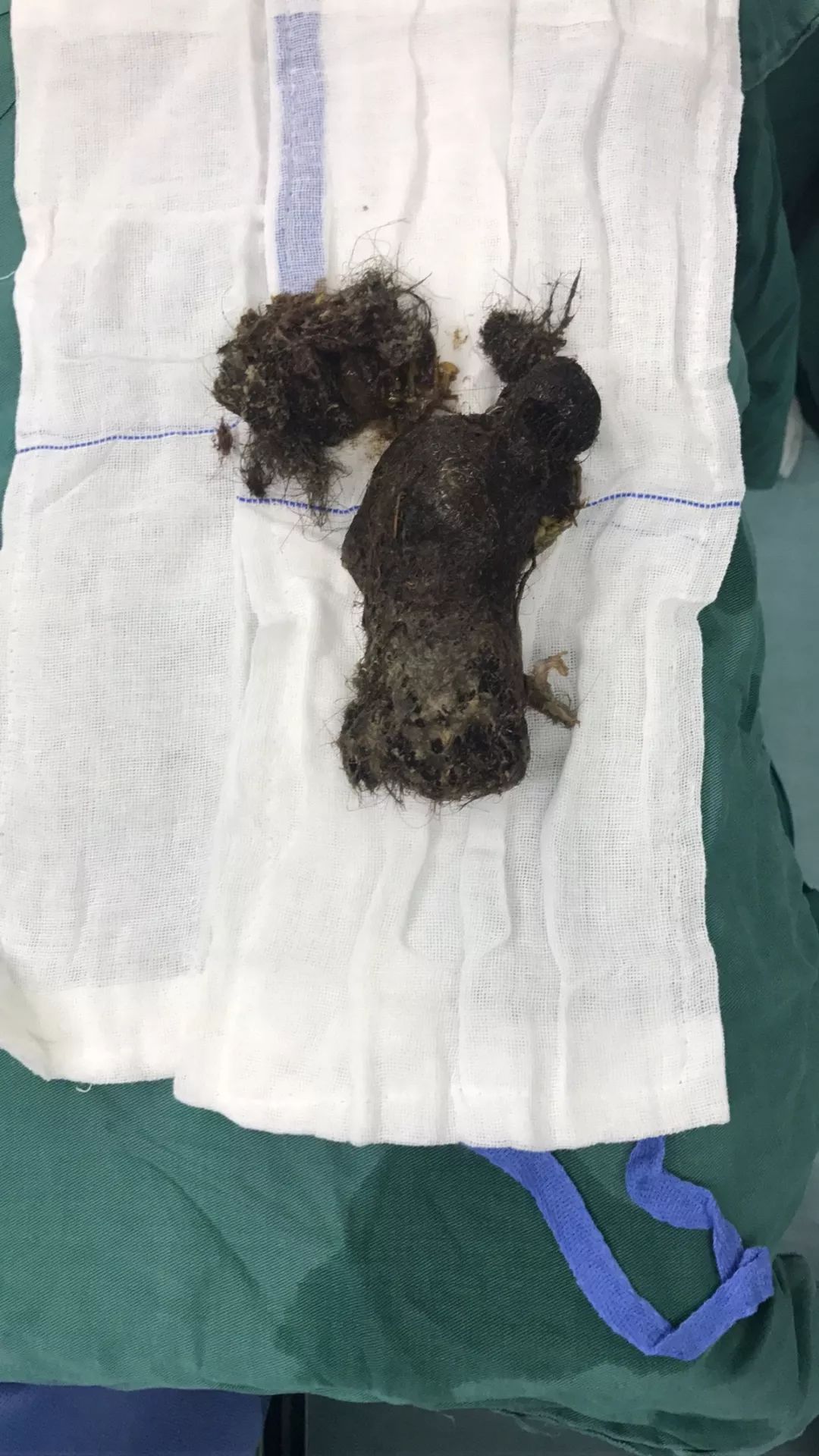 小孩吃了一根头发到肚子里怎么办,小孩吃了一根头发进肚子里