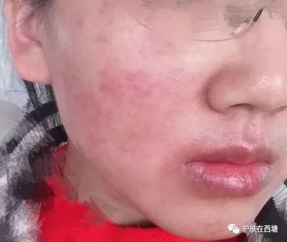 面部敏感性皮炎科普知识,激素依赖性皮炎是什么皮肤病