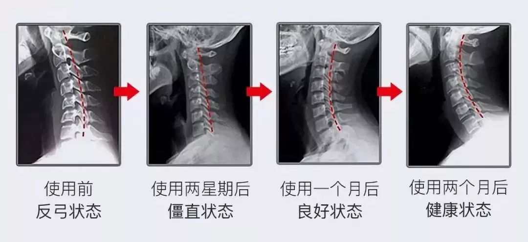 日本护颈神器有用吗视频,护颈最好的神器