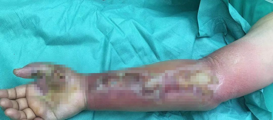 被虾刺破手了会导致什么病,被大虾刺破手指有危险吗