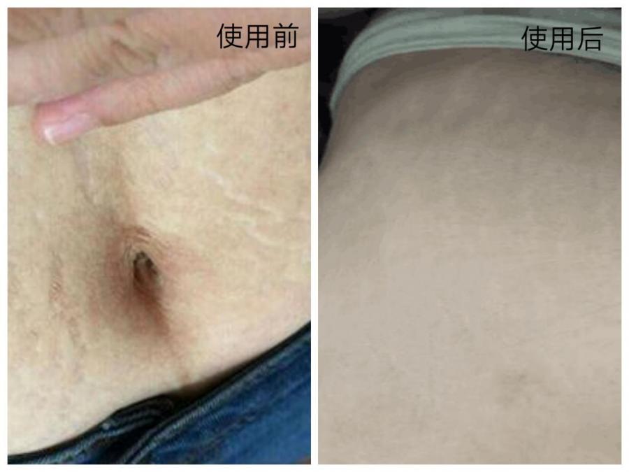 bella小蜜蜂孕妇妊娠纹霜怎么样,bellab小蜜蜂橄榄油和伯特哪个好