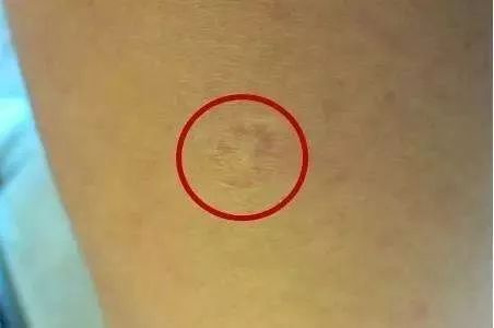 胳膊上的小圆疤是什么,手臂的疤是怎么形成的