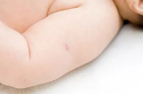 胳膊上的小圆疤是什么,手臂的疤是怎么形成的