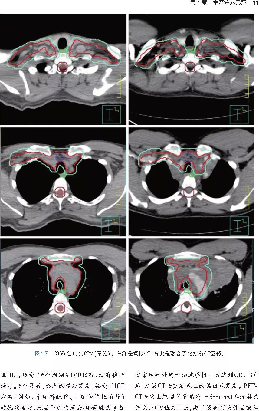 图解血液系统恶性肿瘤放射治疗，如此清晰的指南你见到过吗？